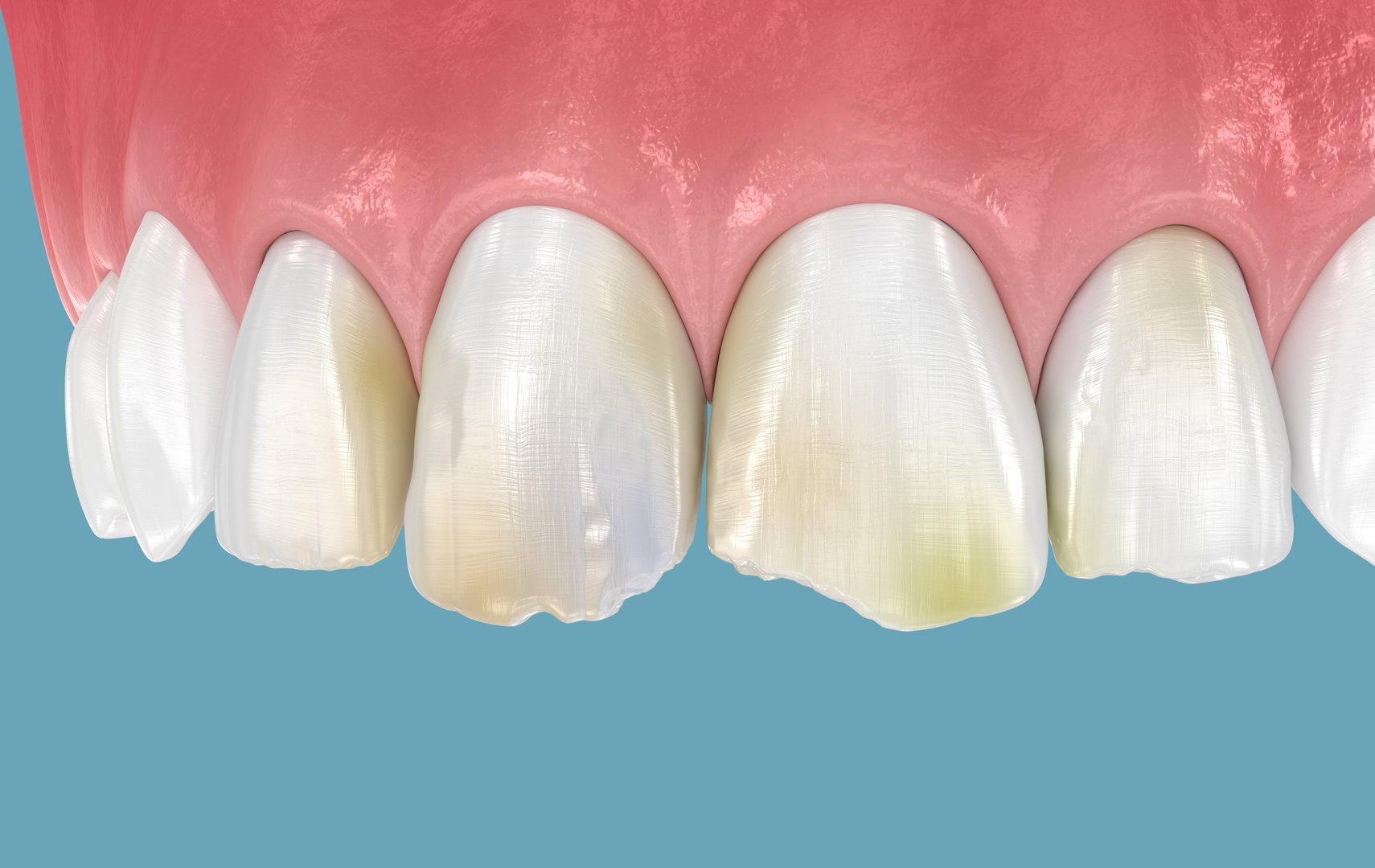 Broken Tooth Treatment