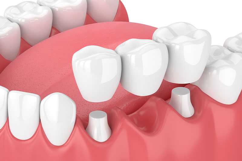 Dental Bridges in Fullerton
