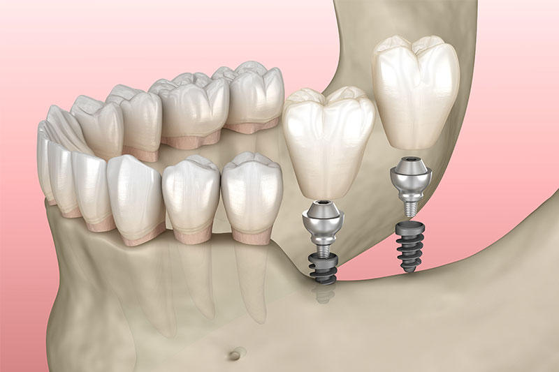 Parts of a Dental Implant in Fullerton