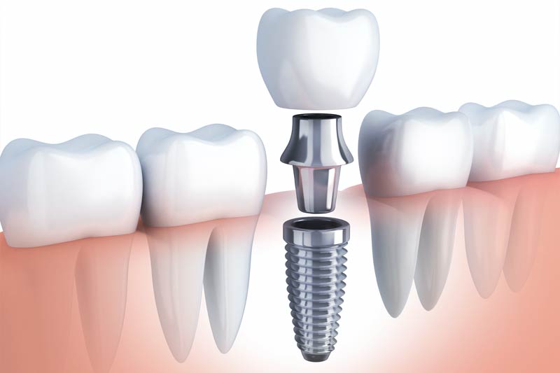 Single Tooth Dental Implant in Fullerton