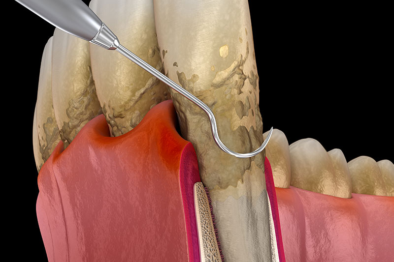 Periodontal Therapy in Fullerton