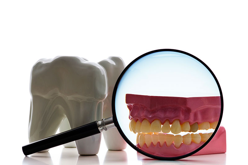 Root Canal in Fullerton