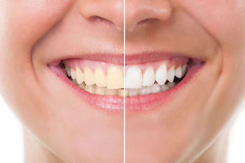Teeth Whitening in Fullerton