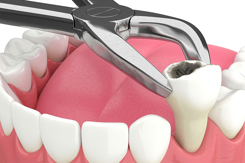 Single Tooth Extraction in Fullerton