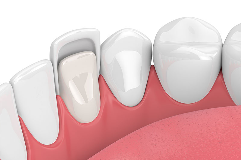 Porcelain Veneers in Fullerton