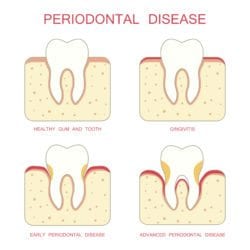bleeding gums treatment fullerton ca