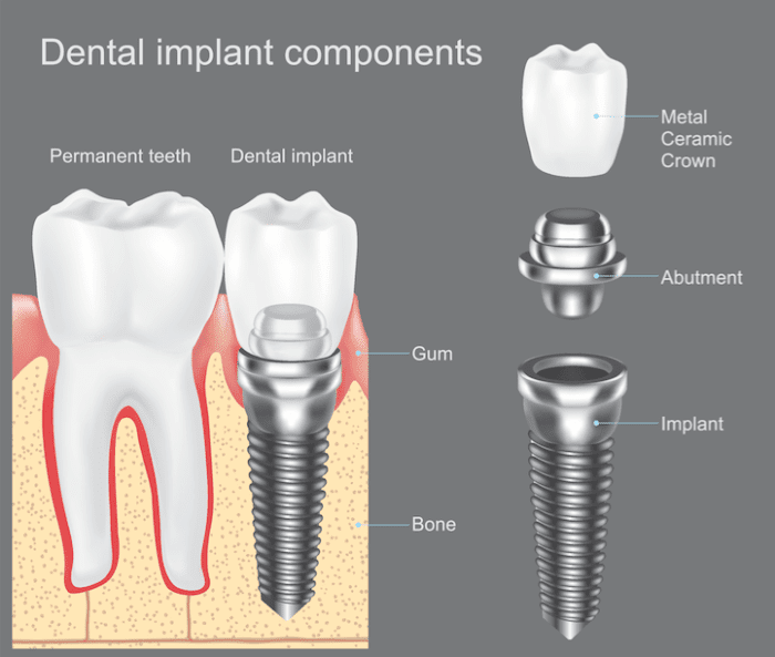 dental implant fullerton, ca