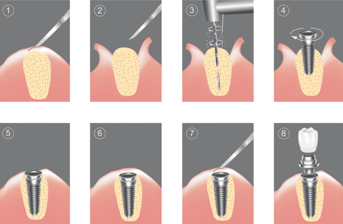 dental implant procedure fullerton ca