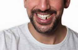Tooth Replacement Solutions at Fullerton Craft Smiles