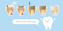 tooth with root canal therapy on the blue background