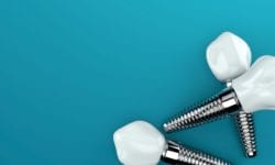 fullerton, ca dental implants