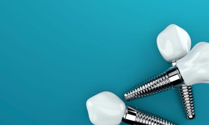 Fullerton, California dental implants