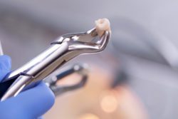 tooth extraction fullerton
