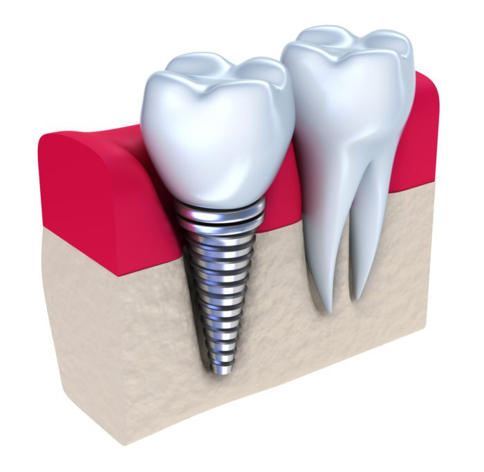 Single Tooth Dental Implant in Fullerton, CA