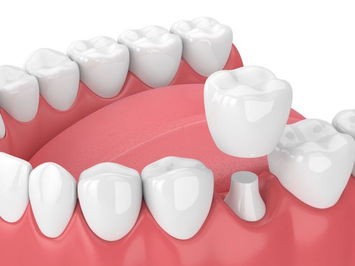 dental crowns in fullerton, california