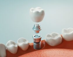 dental implants in Fullerton, CA