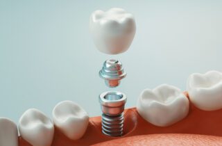 dental implants in Fullerton, CA