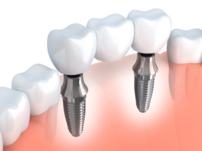 Dental bridge secured with multiple dental implants in Fullerton, CA