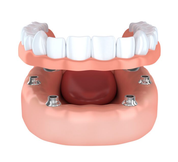 Denture supported by multiple dental implants in Fullerton, CA