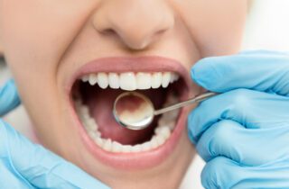 amalgam removal in Anaheim, CA