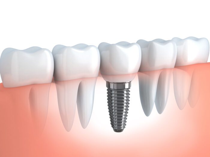 parts of a dental implant in Fullerton, CA