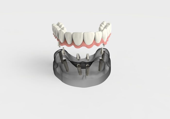 full mouth dental implants in Fullerton, CA