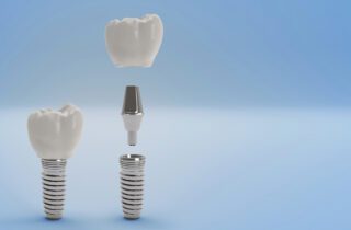 Is Dental Implant Treatment Painful?