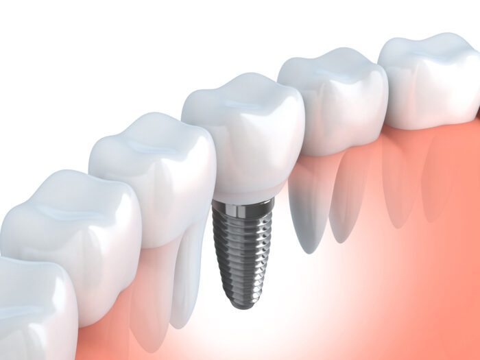 Benefits of Dental Implants Fullerton, CA