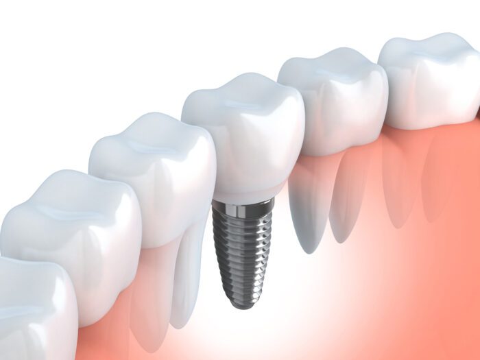Benefits of Dental Implants Fullerton, CA