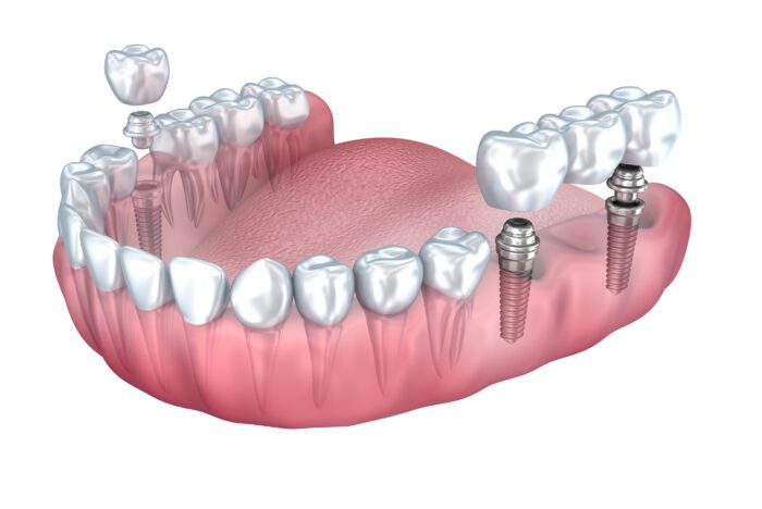 The cost of dental implants in Fullerton, CA