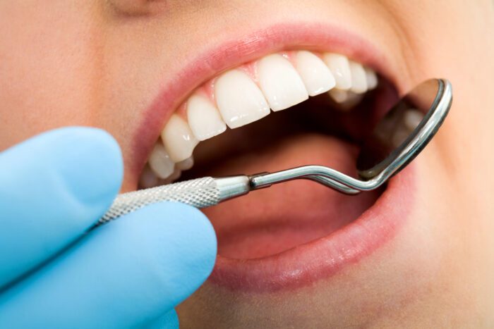 When To Replace Metal Fillings