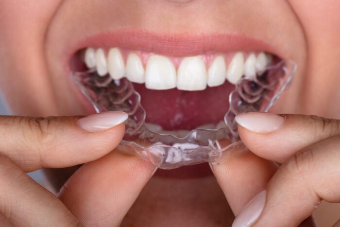 Invisalign in Fullerton, CA, could help improve your smile
