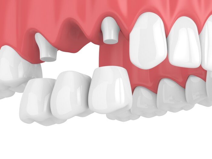 DENTAL BRIDGES in FULLERTON CA can help restore your bite after losing teeth