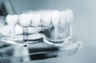 DENTAL IMPLANTS in FULLERTON CA can be beneficial, but they aren't always available for everyone