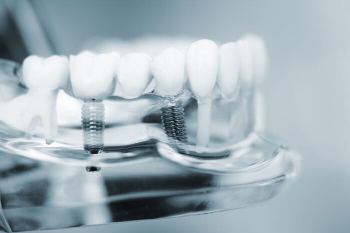 DENTAL IMPLANTS in FULLERTON CA can be beneficial, but they aren't always available for everyone