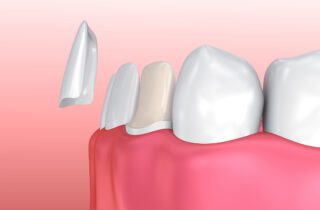 Porcelain veneers could offer an effective solution for various dental issues such as discolored, worn down, chipped, or broken teeth.