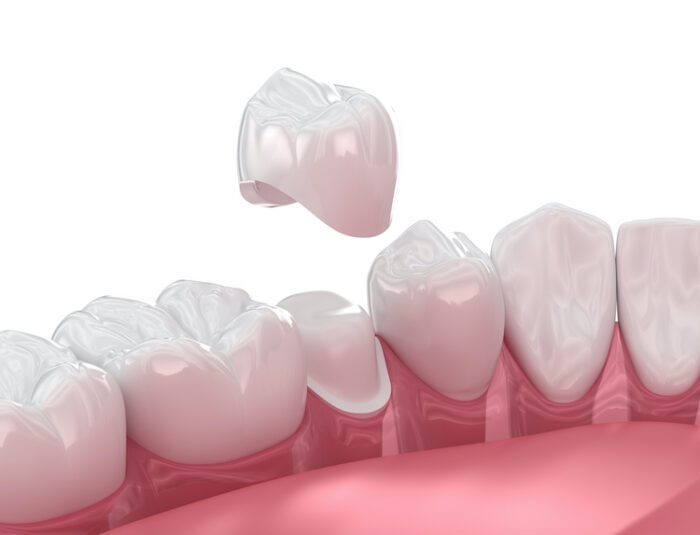 A dental crown can last many years with the right maintenance. Understanding how to care for them is essential for anyone who has one.