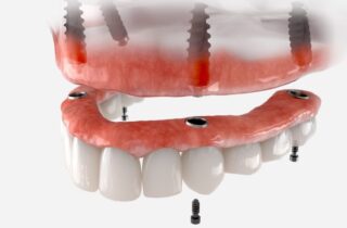 The functionality and aesthetics of full mouth dental implants make them a preferred choice for many with tooth loss.